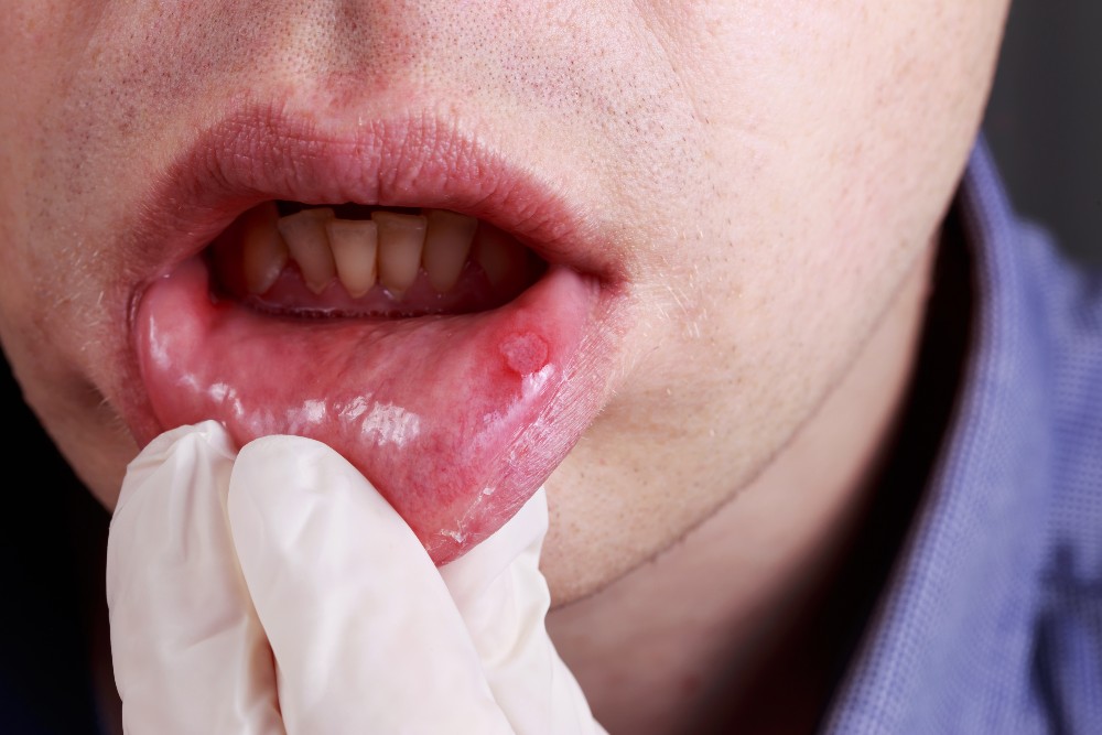 Canker Sores After Wisdom Tooth Removal